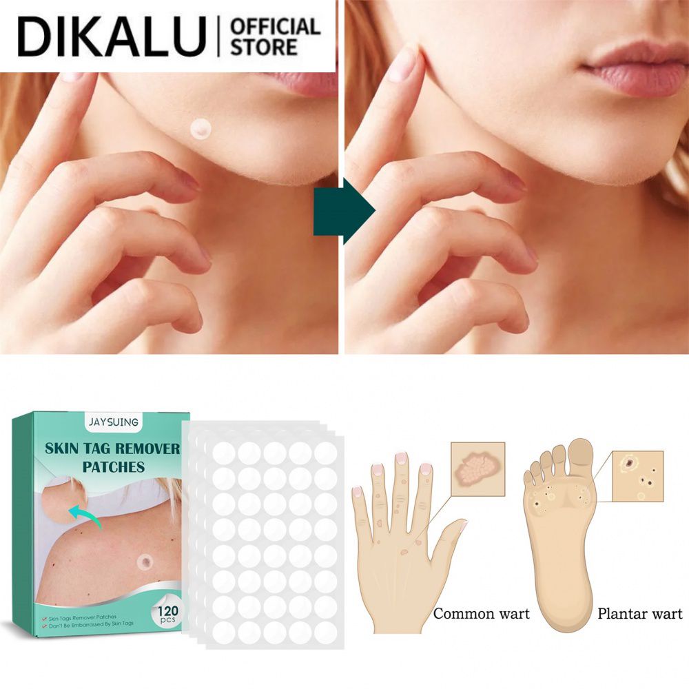 Miếng dán loại bỏ mụn thịt dư DIKALU hỗ trợ giảm mụn cóc an toàn không đau tác dụng nhanh