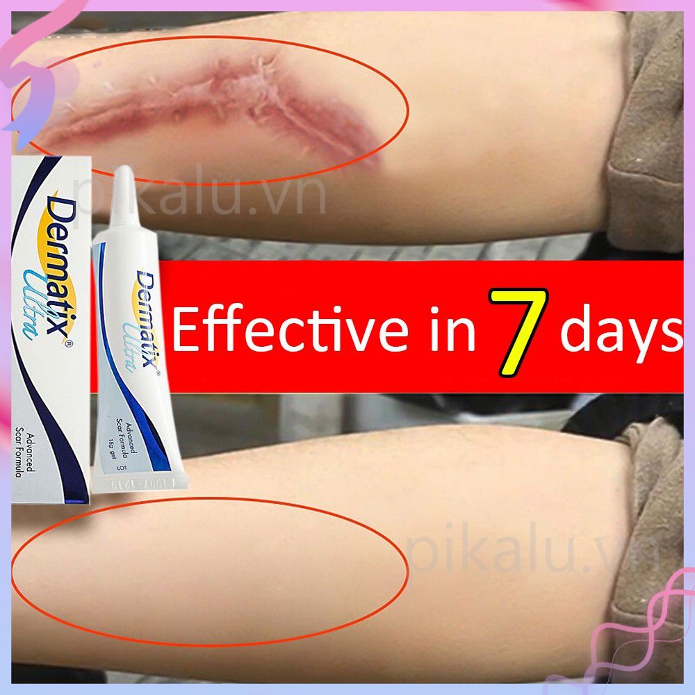 Kem xóa sẹo Dermatix Ultra Gel 15g [ CHÍNH HÃNG .pikalu