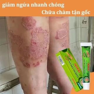 Kem bôi viêm da cơ địa, hắc lào, nấm ngứa đầu, chàm, tổ đỉa, ghẻ nước, lang ben, á sừng, vảy nến