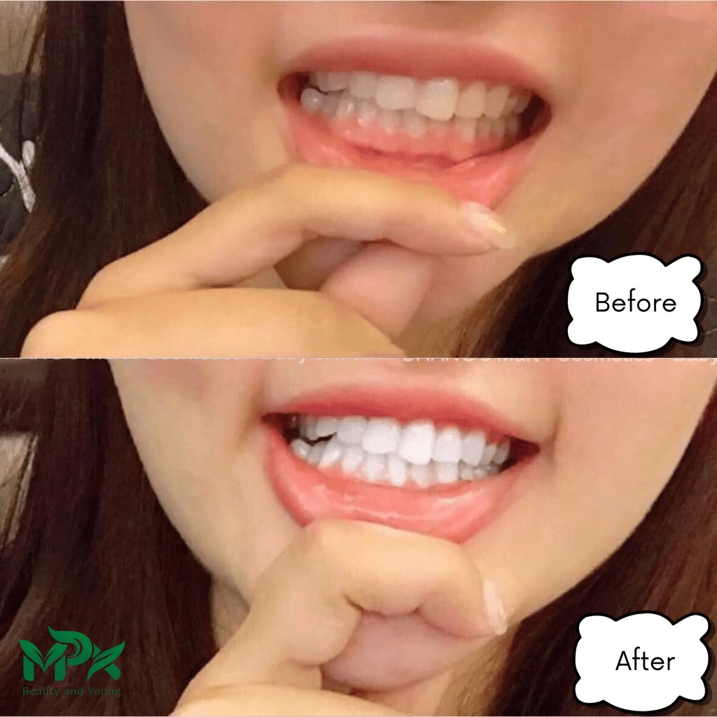 Kem Đánh Răng Median Dental IQ 93% Hàn Quốc 120g Làm Trắng Răng - ATM Mart