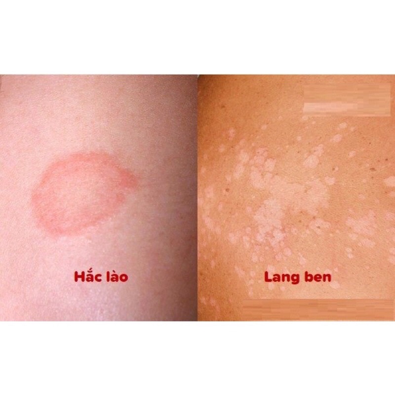 ✅ Cồn ASA Combo 10 lọ Asa Bôi nấm ngứa hắc lào