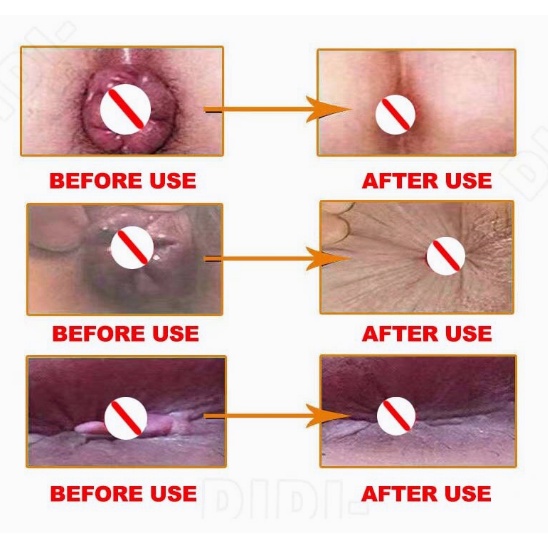 Nhật Bản Kem bôi trĩ- Dùng khi bị trĩ và rát hậu môn, thành phần thảo dược làm dịu mát, giảm đau rát, tuýp 20gr