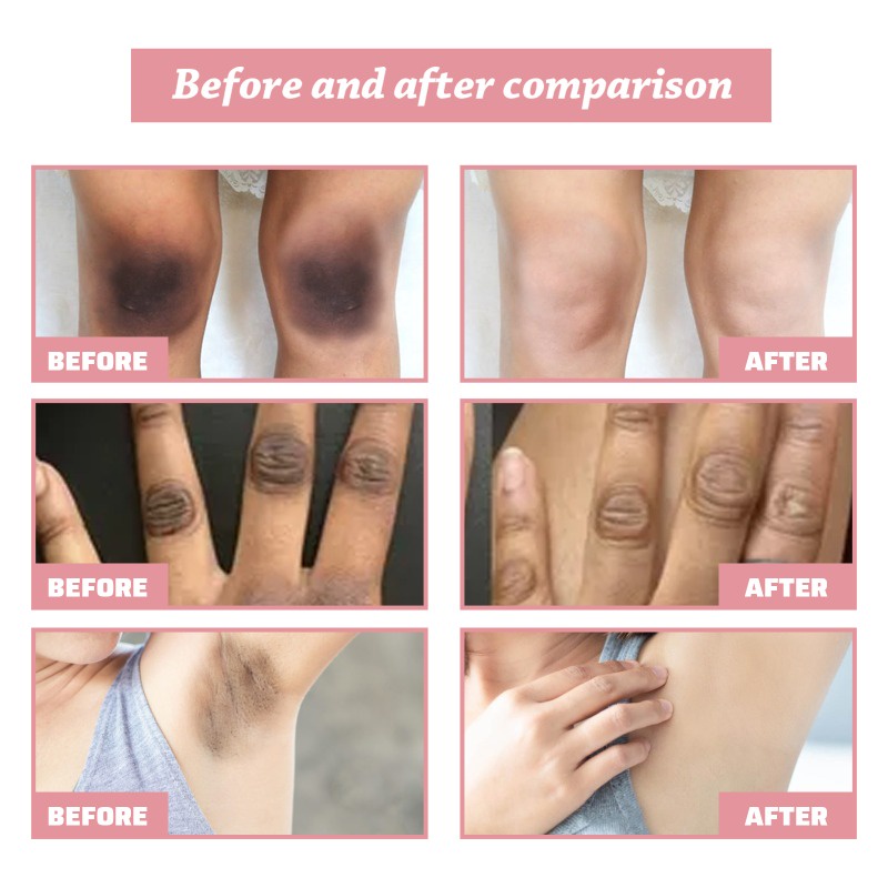 Kem Dưỡng Trắng Da Toàn Thân Kasys Làm Mờ Đốt Đen Dưỡng Ẩm