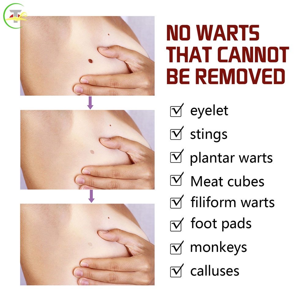 Arts Bút Tẩy Mụn Thịt Dư Trên Da Mặt Tiện Dụng