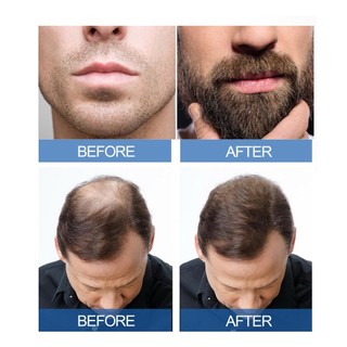 Tinh Chất Kích Thích Mọc Tóc minoxidil 5% minoxidil 60ml