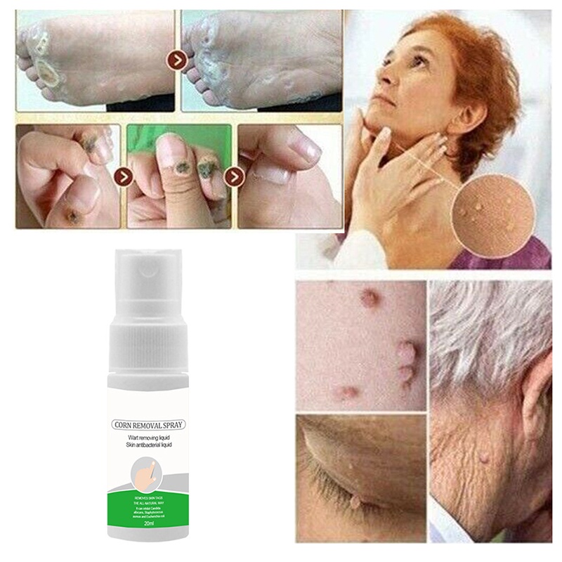 Xịt Tẩy Mụn Thịt Dư Trên Cơ Thể 0.7 oz Tại Nhà