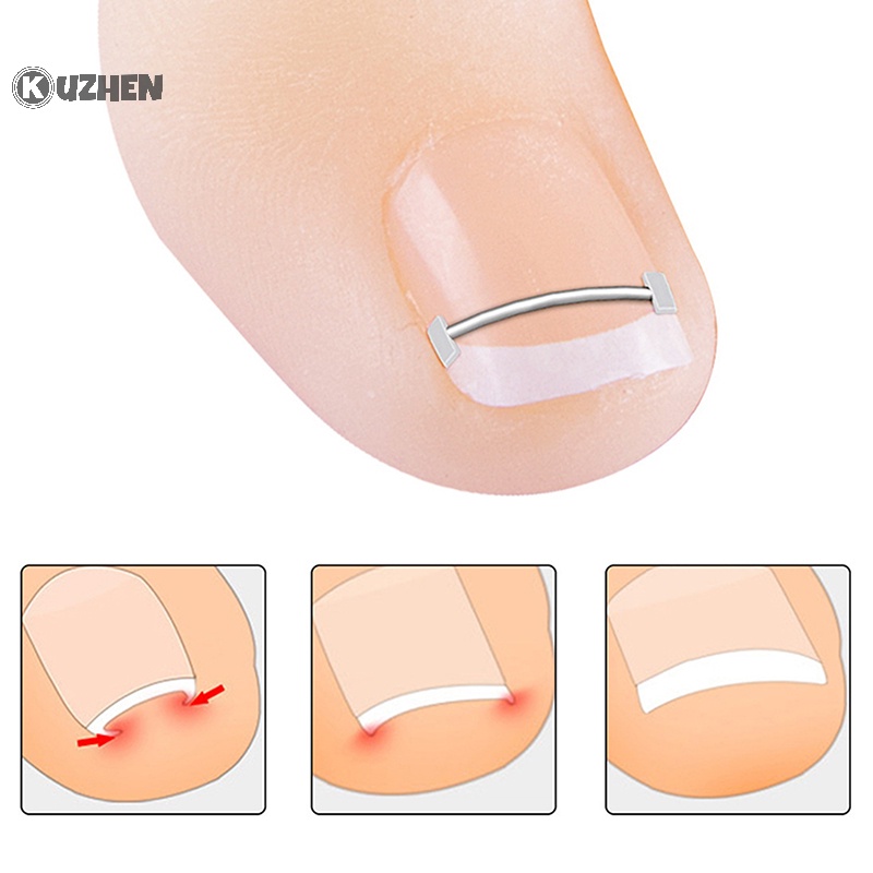 Móng chân mọc ngược KUZHEN