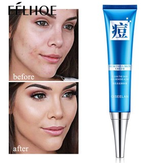 Kem hỗ trợ giảm mụn thành phần thực vật tự nhiên hydrat hóa cho mọi người