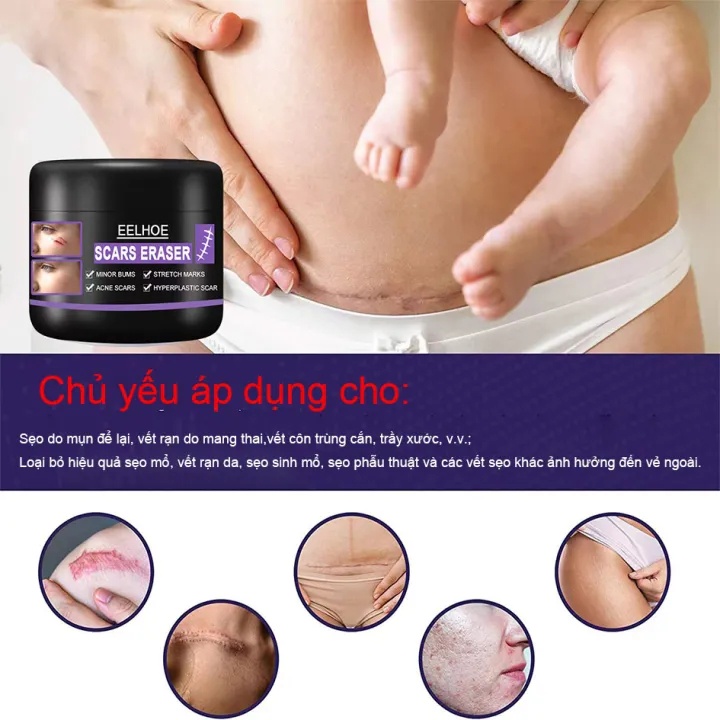 Kem xóa vết rạn da chống nhăn chống lão hóa cho phụ nữ Trẻ hóa làn da Xóa sẹo khi mang thai Chăm sóc cơ thể/50g- intl