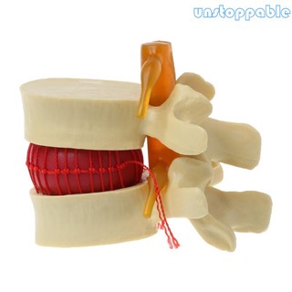 Mô Hình Bộ Xương Giải Phẫu Xương Người Không * Giải Phẫu Xương Cột Sống Đĩa Thắt Lưng Dạy Herniation