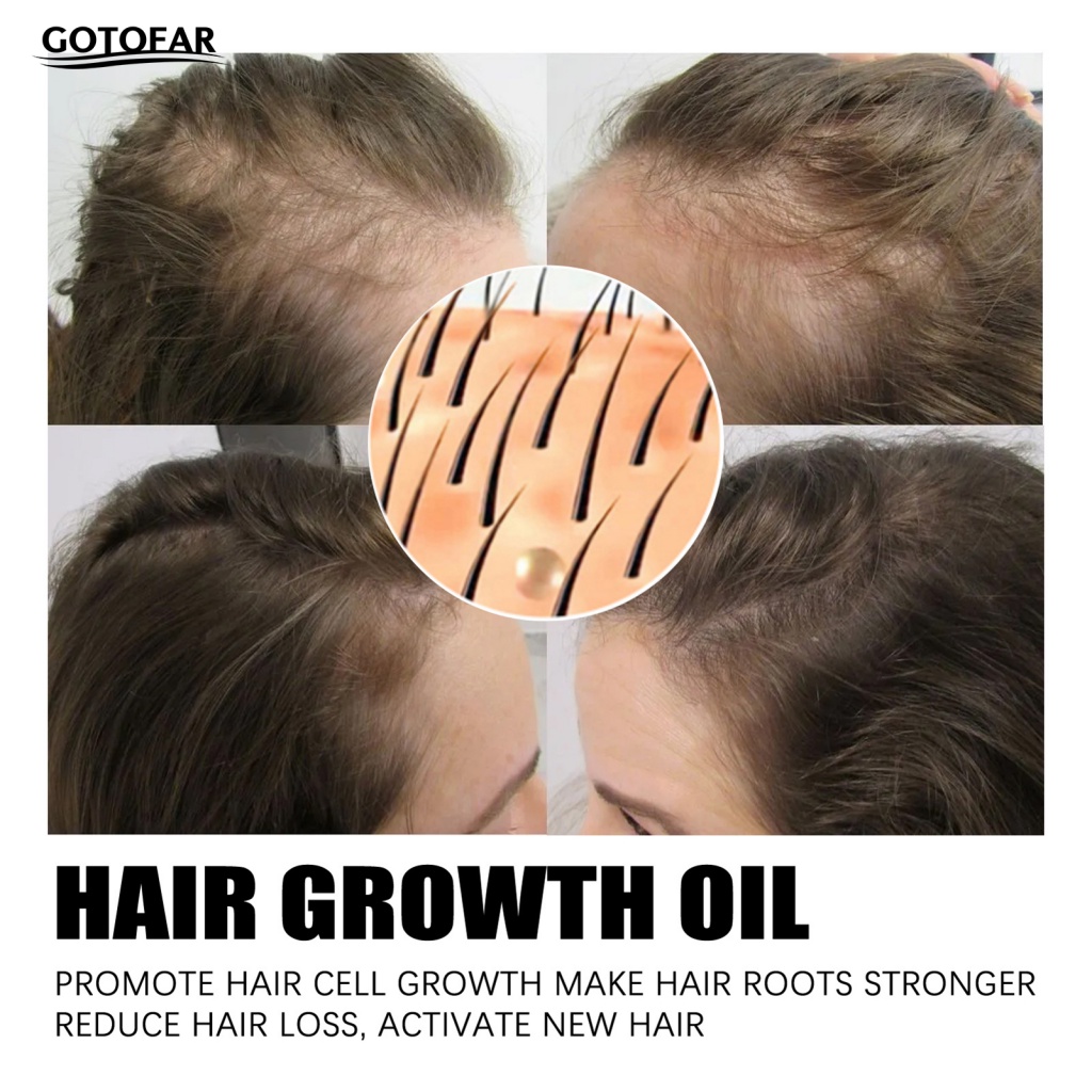 Tinh Dầu Kích Thích Mọc Tóc Tại Nhà 30ml