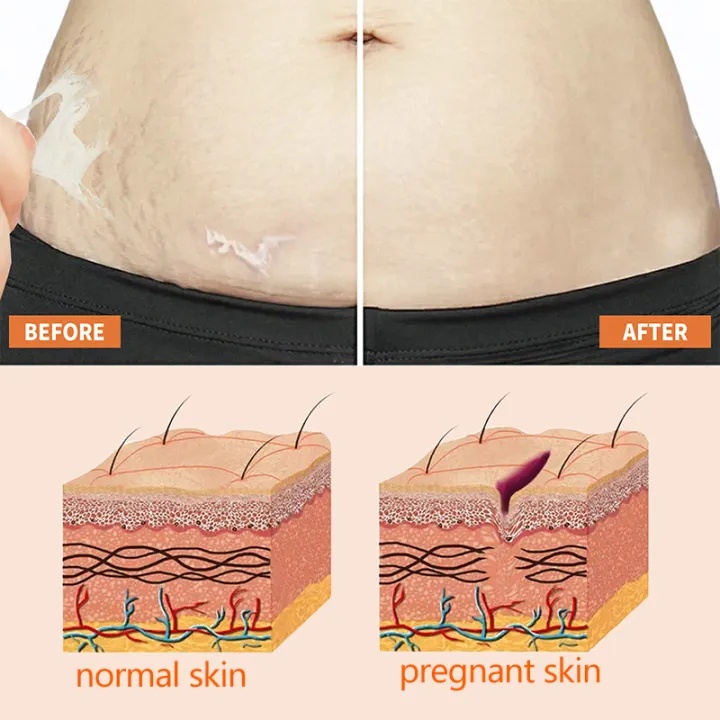 Kem xóa vết rạn da chống nhăn chống lão hóa cho phụ nữ Trẻ hóa làn da Xóa sẹo khi mang thai Chăm sóc cơ thể/50g- intl