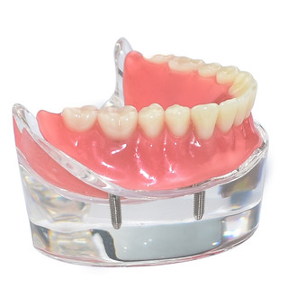Mô hình hàm răng 4 cành có thể tháo rời