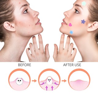 Set 40 / 36 Miếng Dán Mụn Hydrocolloid Chăm Sóc Da