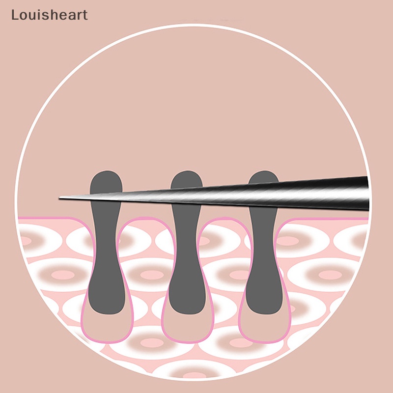 Louisheart Nhíp 8cm Loại Bỏ Mụn Đầu Đen Chuyên Dụng