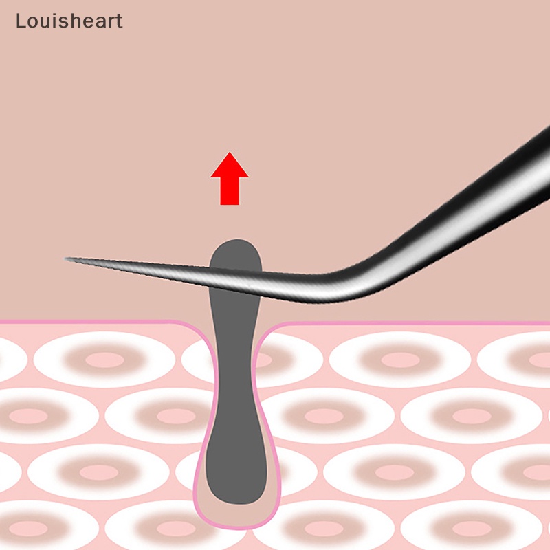 Louisheart Nhíp 8cm Loại Bỏ Mụn Đầu Đen Chuyên Dụng