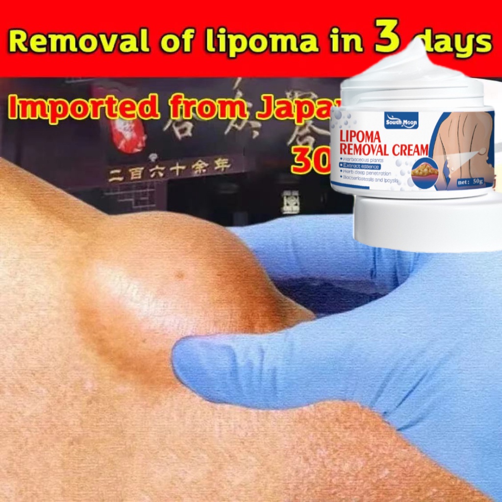 Kem mềm u mỡ Lipoma Cream Tan U fat soluble U hard u fat 50g, 99% remove tumor fat effectively