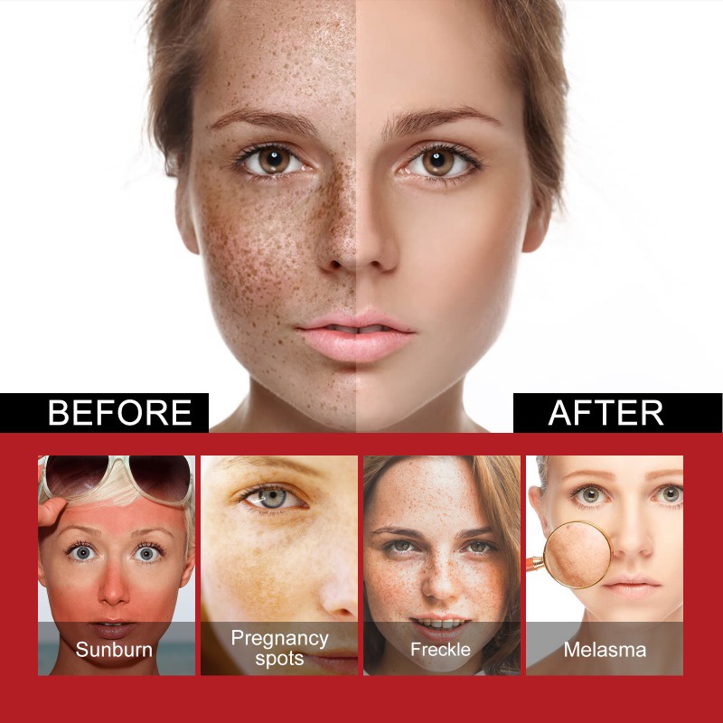 Kem Dưỡng Ẩm Kasys Làm Trắng Da Xóa Mờ Vết Thâm Và Tàn Nhang