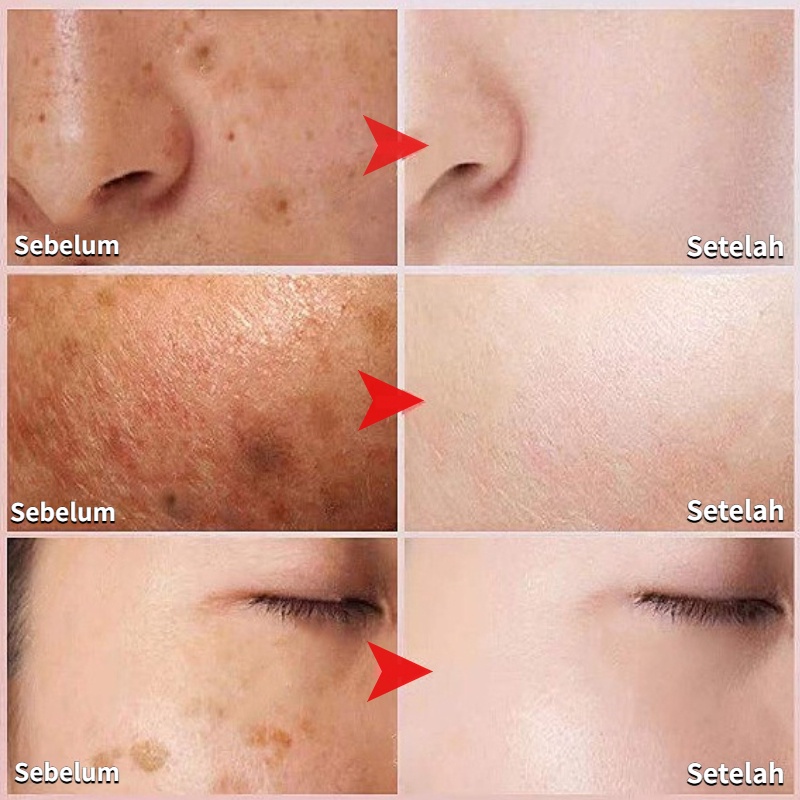 YOUBUY Kem Dưỡng Trắng Da Loại Bỏ Tàn Nhang 20g