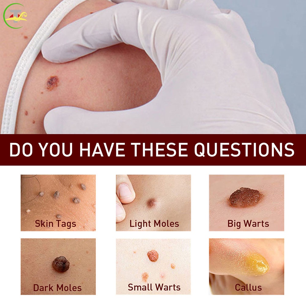 Arts Bút Tẩy Mụn Thịt Dư Trên Da Mặt Tiện Dụng