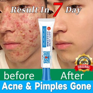 Kem trị mụn acne gel điều trị mụn sẹo tẩy chăm sóc da lỗ chân lông pangtangal mụn pampakinis aubessds