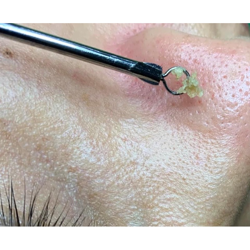 Que Nặn Mụn Malika Loại 1 Thép Không Gỉ