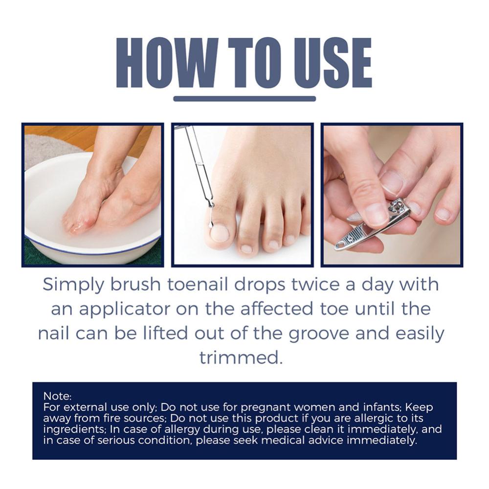 Dầu paronychia 10ml Làm Mềm Móng Chân Giảm Đau b4c7