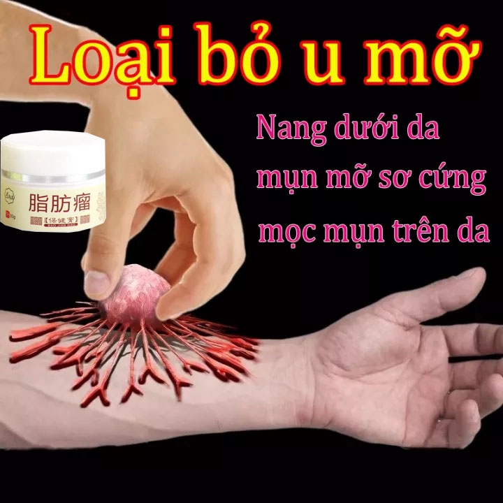 Kem tan mỡ chính hãng cho nhiều cục u dưới da đơn lẻ u tuyến giáp u mỡ dưới da dạng sợi kem bôi u bướu mỡ