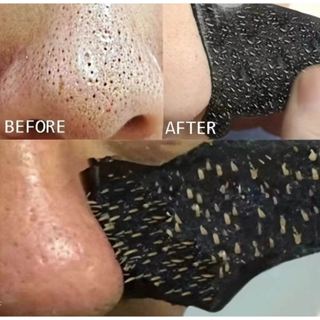 Miếng Dán Lột Mụn Đầu Đen Vùng Mũi An Toàn Tiện Lợi Dành Cho Gia Đình