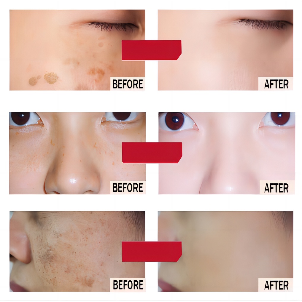 30G Kem Trị Nám Lotion Pekas Tẩy Trắng Da Tàn Nhang Kem Vết Đen Tẩy Trắng Da Nhanh Chóng Làm Sáng Da AubessDS