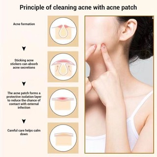 Set 40 / 36 Miếng Dán Mụn Hydrocolloid Chăm Sóc Da
