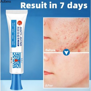 Mụn tẩy mụn kem trị mụn trị thâm sẹo tẩy chăm sóc da kem trị mụn aubessds