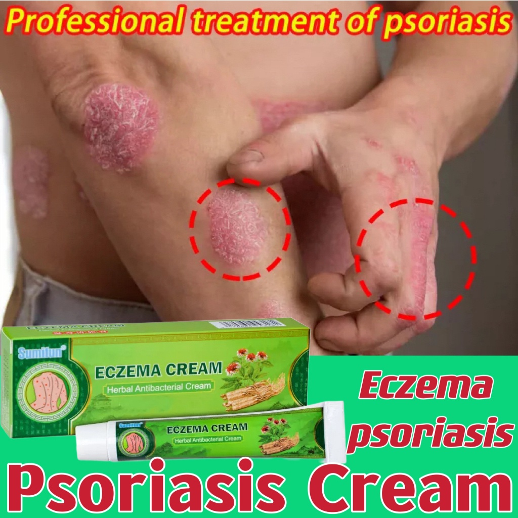 Kem bôi vẩy nến, viêm da kháng khuẩn đánh bay nấm da, chống ngứa viêm da, hắc lào, lang ben, mề đay, á sừng, vảy nến