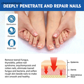 10 Miếng Dán Chỉnh Sửa Móng Tay Ingrown Móng Chân Onychomycosis Sửa Chữa Miến