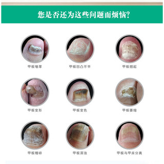 Ưu tiên Boutique#普维柯亮甲抑菌液灰指甲药亮甲新套装亮甲抑菌剂套装可OEMWY3