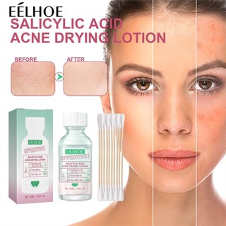 Ouhoe Salicylic Acid Kem dưỡng da Hỗ trợ giảm mụn nhẹ nhàng Sửa chữa mụn trứng cá Tinh chỉnh lỗ chân lông Da mặt Kem dưỡng ẩm
