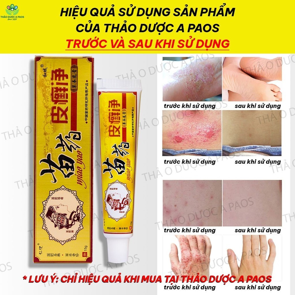 Kem CÔ GÁI MIAO YAO chuyên bôi hắc lào, nấm ngứa, á sừng,vẩy nến, ngứa da đầu, ghẻ nước hắc lào