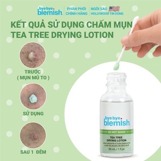 Lotion Chấm Mụn Bye Bye Blemish Dành Cho Mụn Sưng  30ml