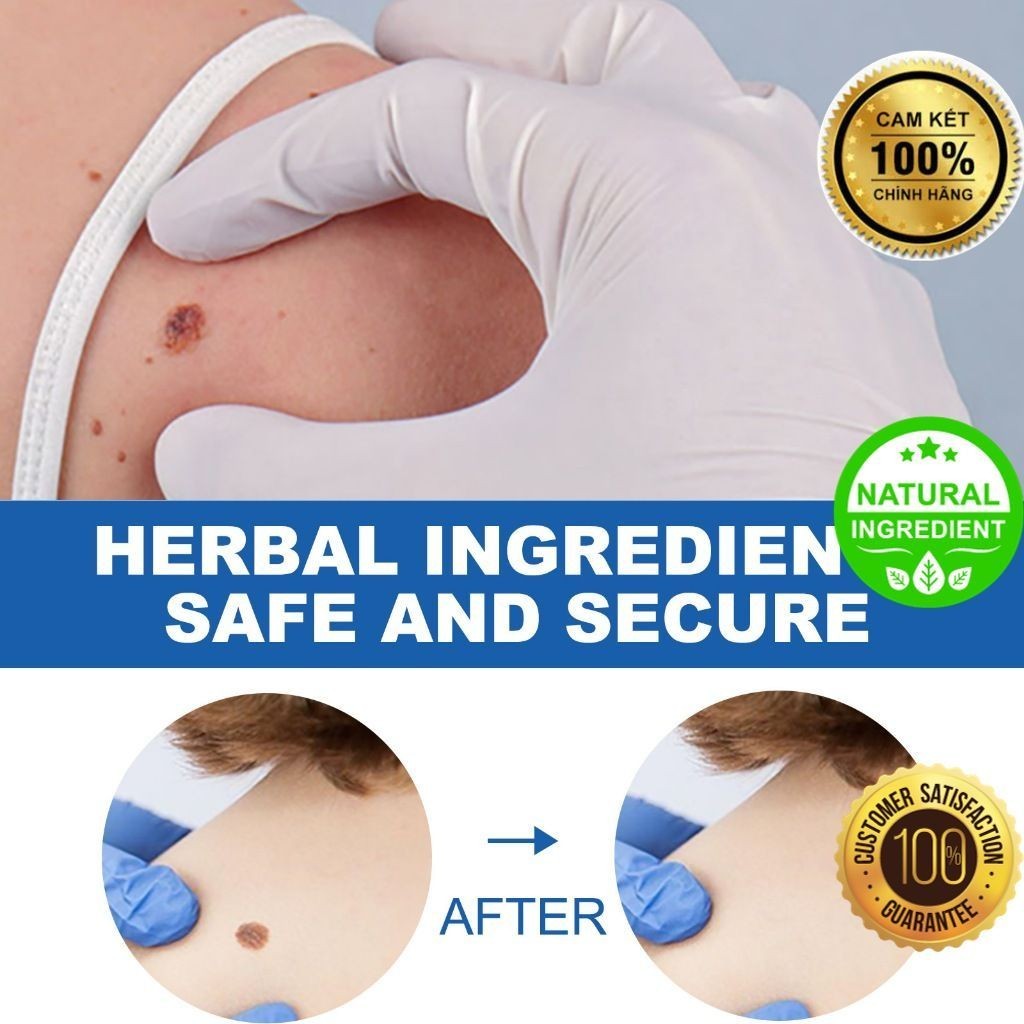 Bút EELHOE Chấm Mụn Thịt, Nốt Ruồi, Mụn Cóc, Mụn Thịt Thừa, cam kết an toàn và hiệu quả  [Herbal Mall]