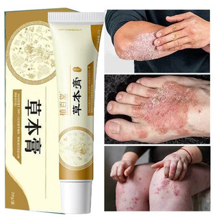 Kem bôi nấm ngứa, vảy nến，á sừng, hắc lào, lang ben, tổ đỉa, viêm da cơ địa hàng nội địa Trung