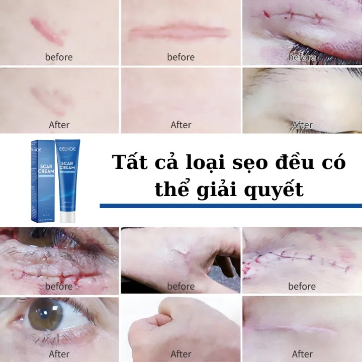 Kem xóa sẹo, loại bỏ hiệu quả các vết sẹo lâu năm, sẹo phẫu thuật, phục hồi và làm sáng các vết rạn da khi mang thai