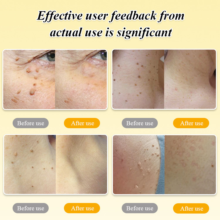 Boomoon Ong Nọc Độc Loại Bỏ Mụn cóc Điều Trị Xịt Ong Nọc Độc Xịt Mụn cóc Tẩy Nốt Ruồi Thẻ Da Loại Bỏ Hạt