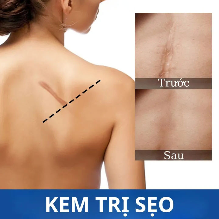 Kem xóa sẹo, loại bỏ hiệu quả các vết sẹo lâu năm, sẹo phẫu thuật, phục hồi và làm sáng các vết rạn da khi mang thai