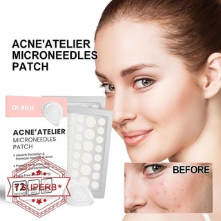 Microneedle Mụn Miếng Dán Loại Bỏ Mụn Miếng Dán Chăm Sóc Mặt Lý Tưởng Cho Điều Hỗ trợ giảm mụn