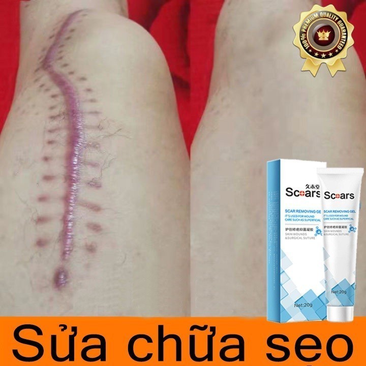 Kem Xóa Sẹo 20g Loại Bỏ Hiệu Quả Các Vết Sẹo Cũ Sẹo Sẹo Phẫu Thuật, Cũ Sẹo Bỏ Sẹo Mụn Trứng Cá Vết Sẹo Muỗi Đốt