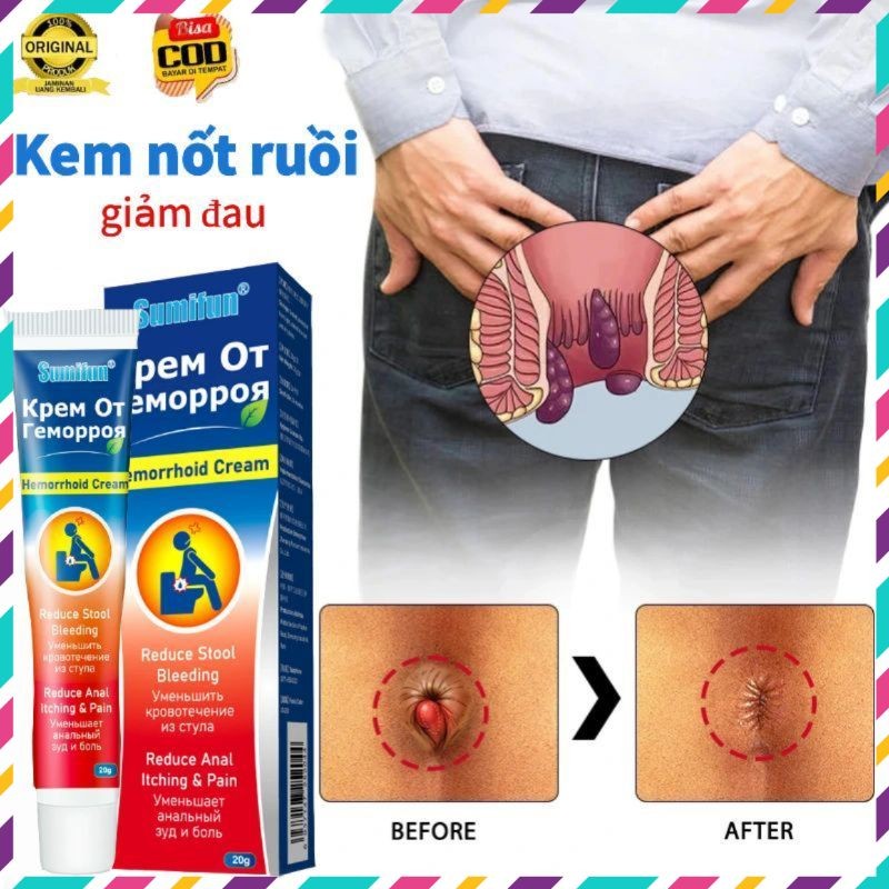 Kem bôi trĩ cải thiện tình trạng trĩ giúp co búi trĩ  - QUEENSHOP68