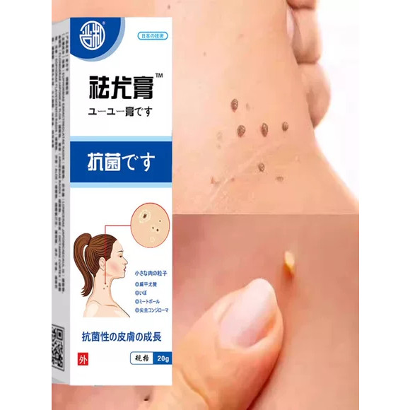 【Nguyên liệu Nhật Bản】Kem bôi loại bỏ mụn thịt nhỏ trên cổ, da thừa, mụn cóc dạng sợi, mụn phẳng, mụ