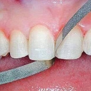 Lá mài kẽ răng,vật liệu răng miệng nhám kẽ răng
