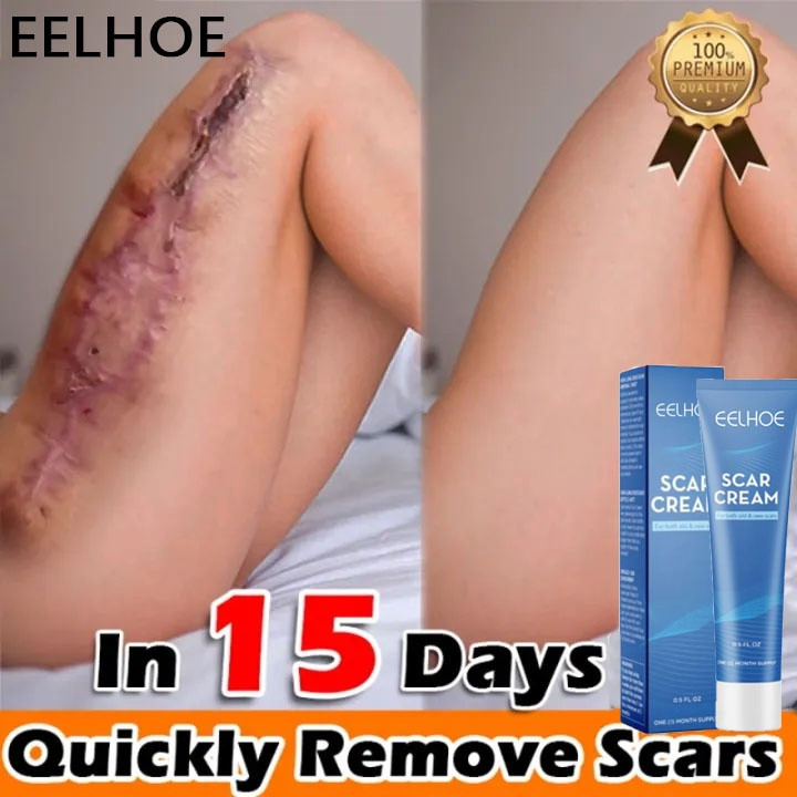 Kem xóa sẹo Kem sẹo Scar Care sẹo do bị thương sẹo bỏng sẹo phẫu thuật sửa chữa tất cả