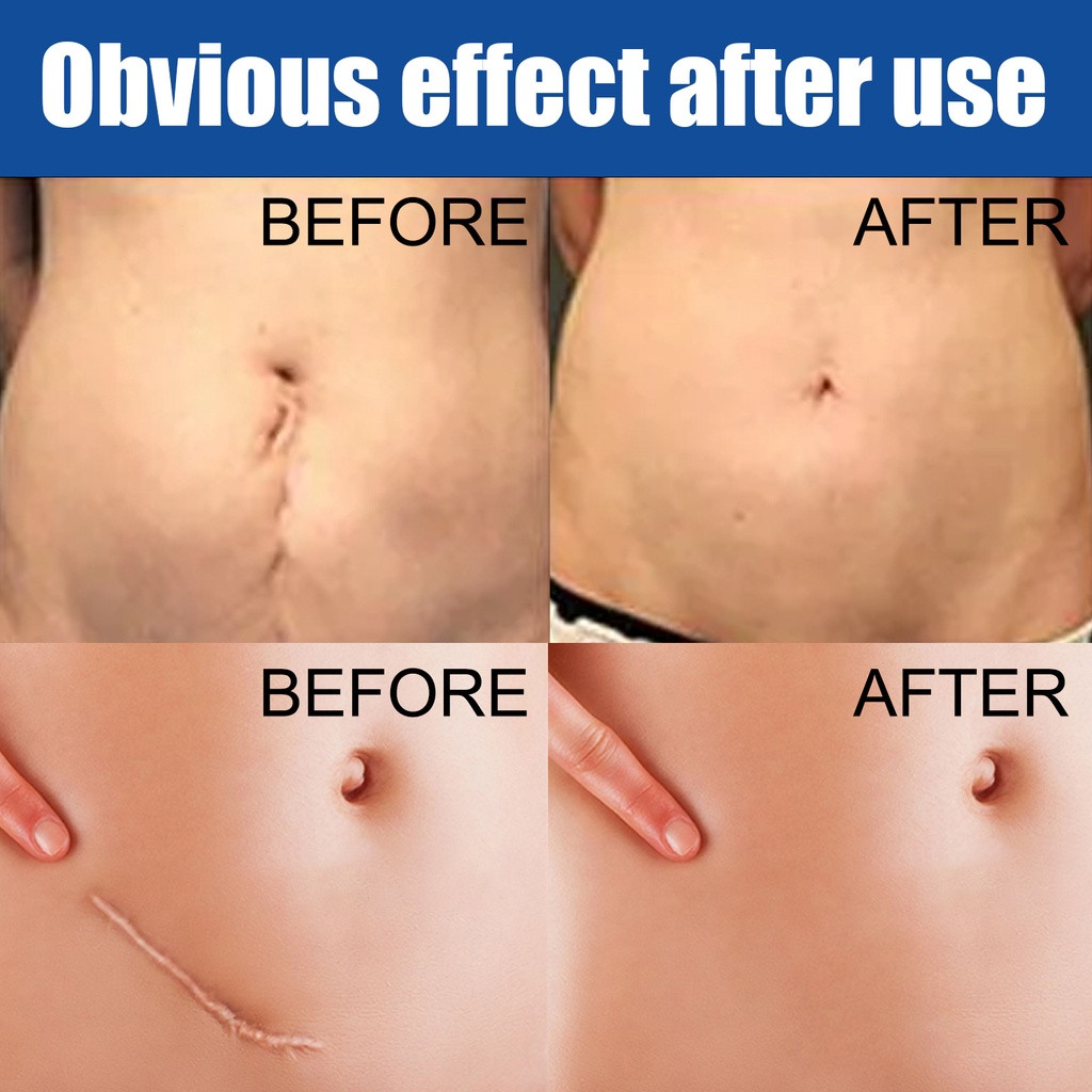Kem xóa sẹo Kem sẹo Scar Care sẹo do bị thương sẹo bỏng sẹo phẫu thuật sửa chữa tất cả